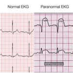 Paranormal EKG 280×280 | Modernnurse Mag